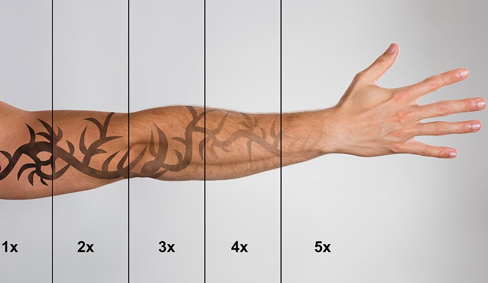 When to Skip At-Home Tattoo Removal Kits
