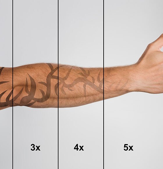 When to Skip At-Home Tattoo Removal Kits