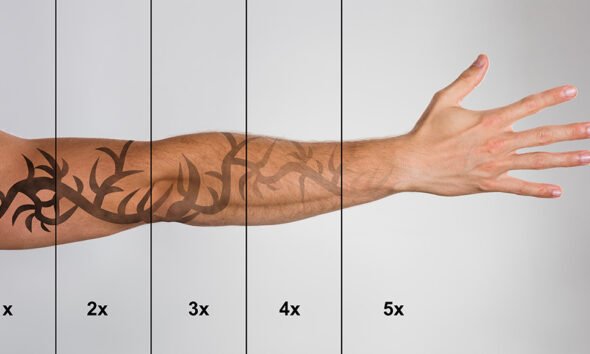When to Skip At-Home Tattoo Removal Kits
