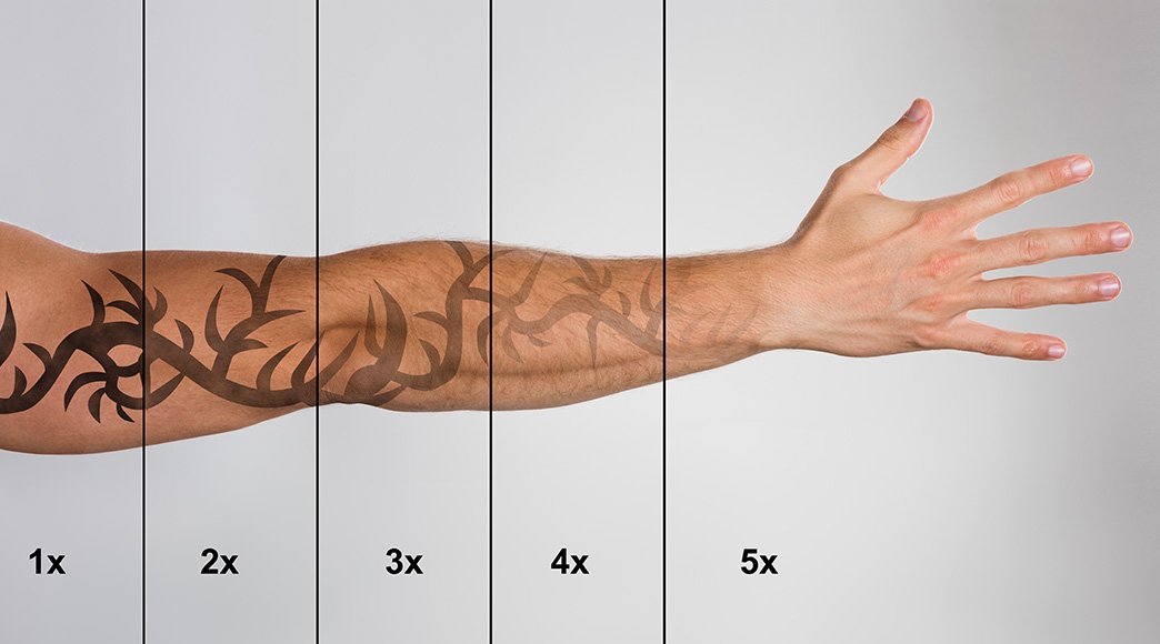 When to Skip At-Home Tattoo Removal Kits